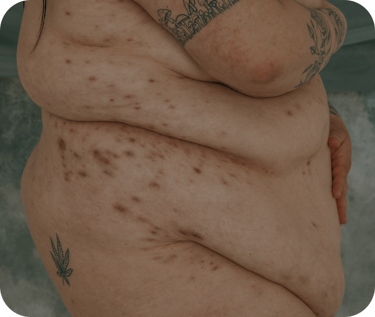 Hidradenitis Supurativa